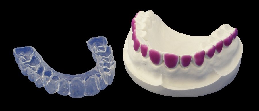 Bleaching trays, teeth whitening trays, with or without reservoirs, scalloped/unscalloped