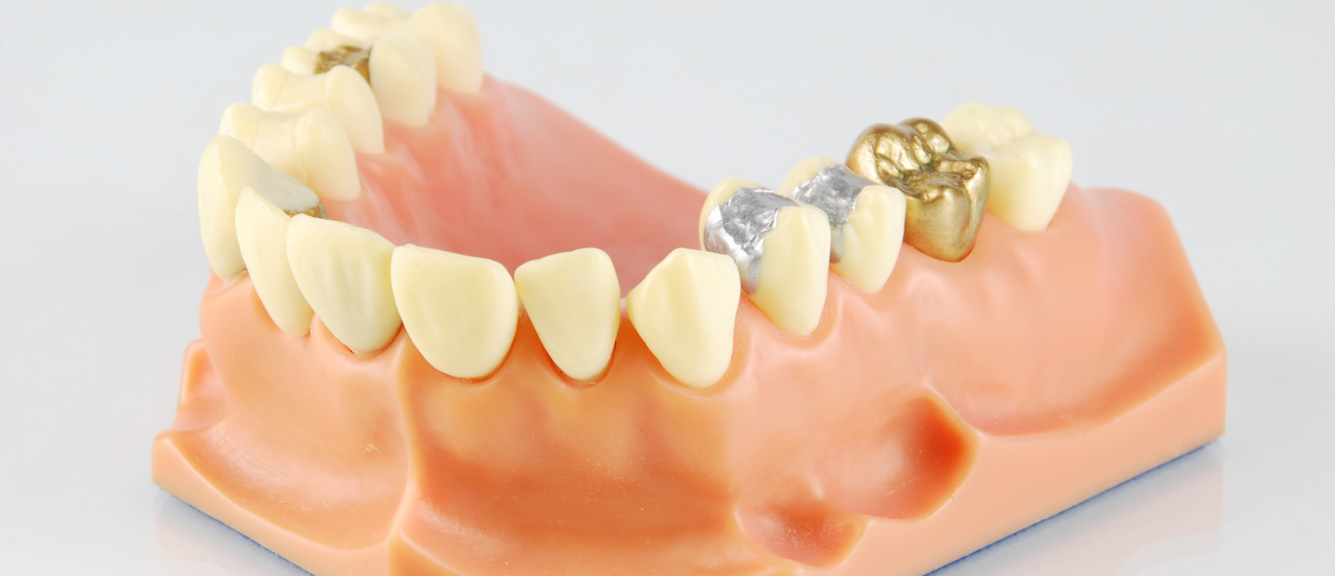 Dental crown and bridge work