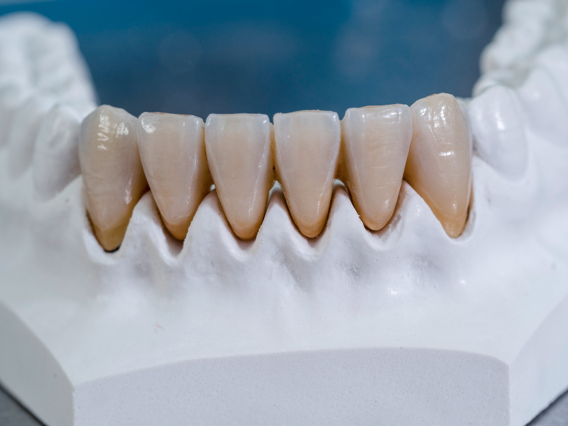 GC Gradia dental crowns, DC Gradia dental bridges